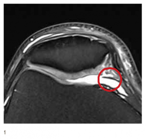 Arthroskopie und Entfernung einer irritierten Plica Mediopatellaris