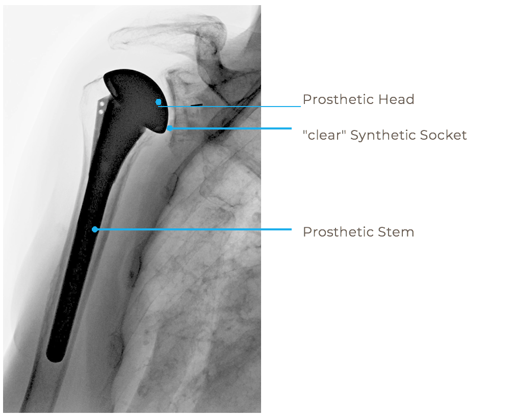 Shoulder Arthroplasty Praxis Leonardo